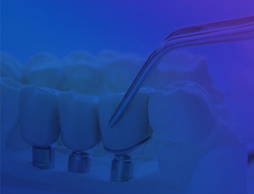 Sugar and Dental Implants: Navigating the Path to Long-Lasting Results