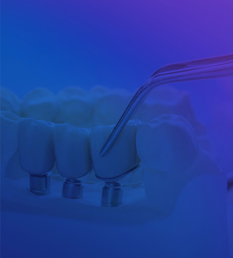 Dental Implants - Top Rated Dentist