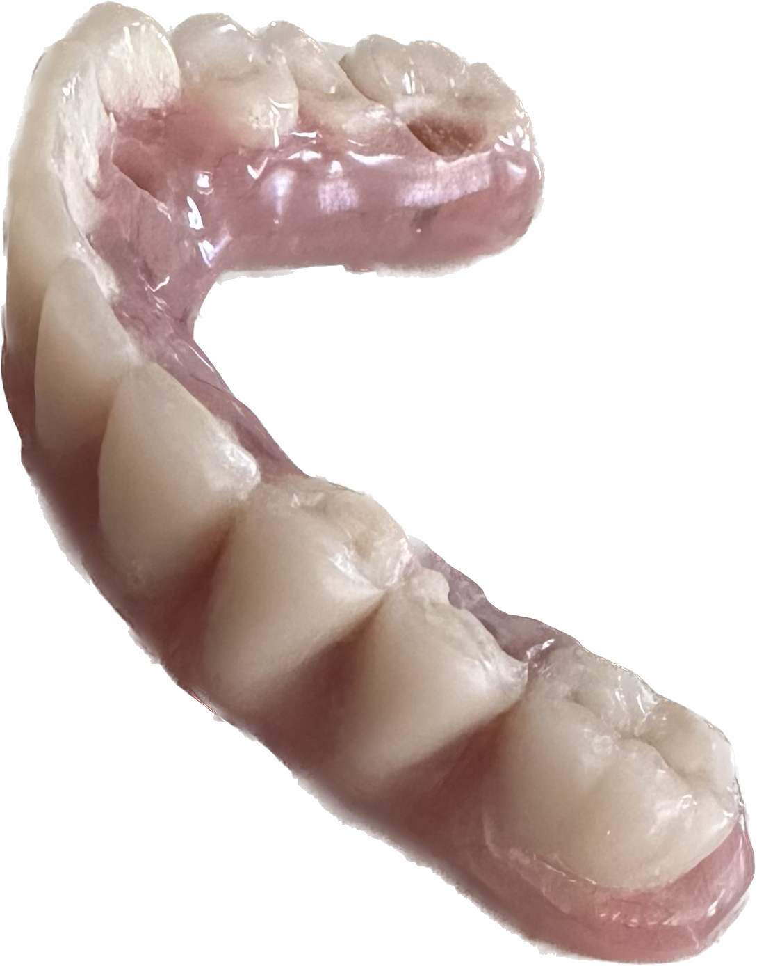 Implant Supported Titanium Screw-in Dentures