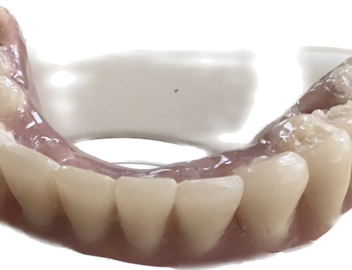Elevate Your Smile with Secure Screw-In Dentures: A Success Story