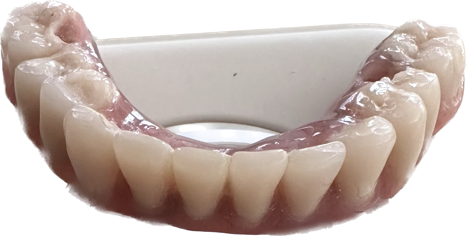 Quality Implant Supported Titanium Screw-in Dentures